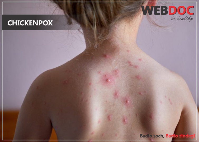 chickenpox